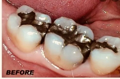 Before Cerec