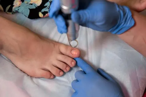 Woman getting laser treatment for toenail fungus removal