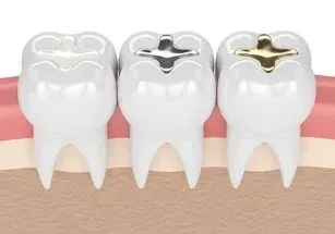 illustration of teeth with different types of dental fillings, Cary, NC family dentist