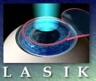Lasik