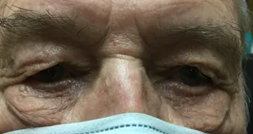 Men-before-blepharoplasty-eyelid-lift-dermatochalasis-phoenix-az-scottsdale