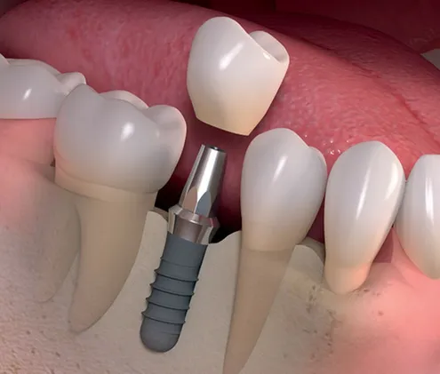 Dental Implants, New York, NY