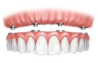 illustration of all teeth being replaced with dental implant dentures, dental implants Melrose, MA dentist
