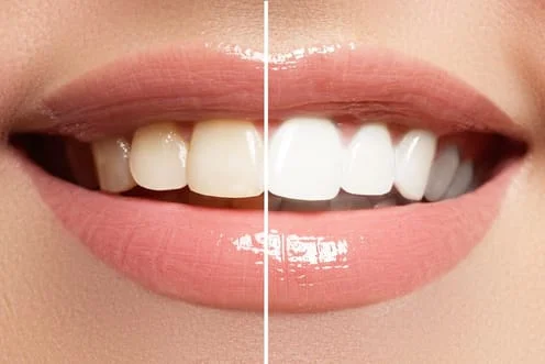 Tooth Whitening | Cosmetic Dentistry in Reston, VA