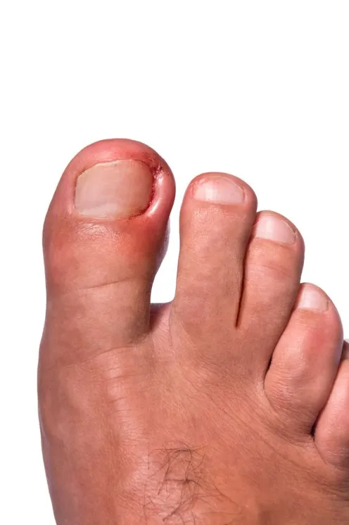 Des Moines Podiatrist | Des Moines Ingrown Toenails | IA | Advanced Foot & Ankle Clinic |