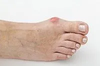 Bunions