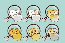 illustration of teeth progressing with cavity decay cosmetic fillings Casa Grande, AZ