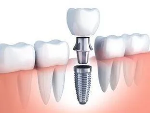 illustration of dental implant parts and assembly to replace tooth, dental implants Peachtree City, GA cosmetic dentistry