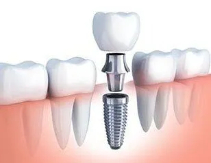 illustration of single dental implant being placed in mouth, dental implants Melrose, MA dentist