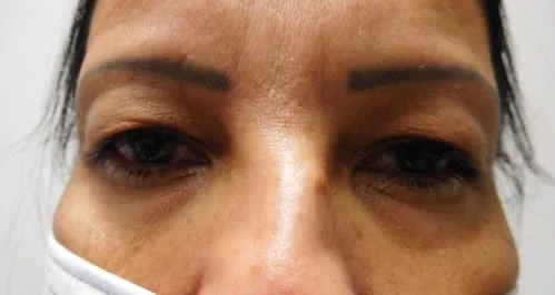 before-cosmetic-eyelid-lift-blepharoplasty-phoenix-arizona-az-scottsdale
