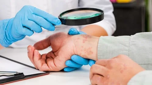 doctor examining psoriasis on wrist