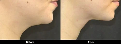 Kybella Before and After Picture