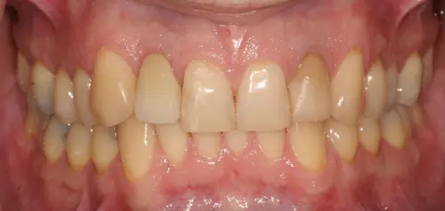 Dental Implant After