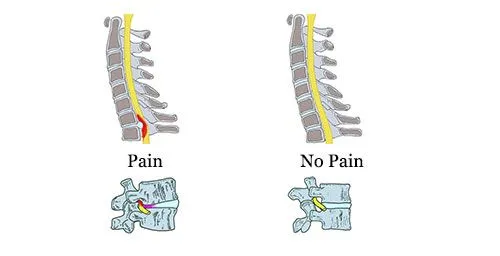 Spinal Decompression by simultaneous Flexion-Distraction