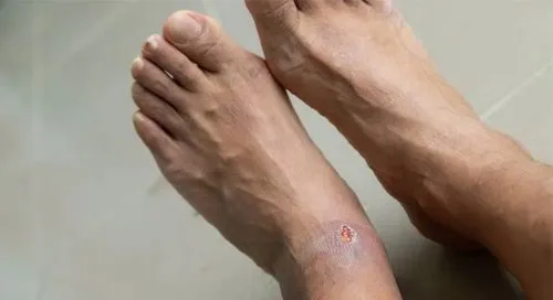 New Revolutionary Wound Care Therapy!!