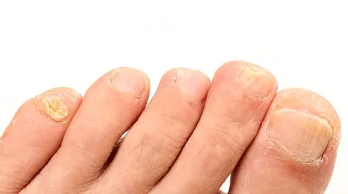 Toenail affected by fungal infection showing yellow discoloration