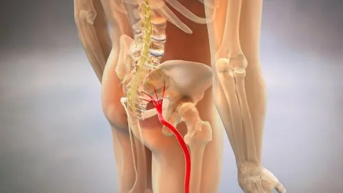 Understanding Sciatica