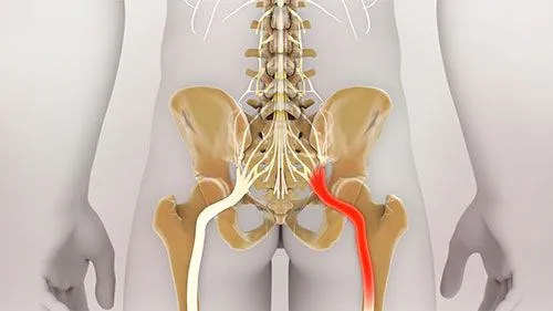 What is sciatica?