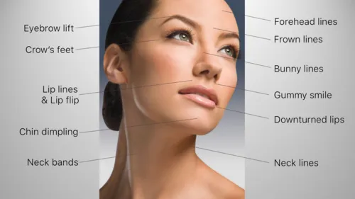 Botox/Dysport - Houston, TX Dermatologist