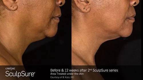 Bra Bulge Treatment, SculpSure Southern Maryland