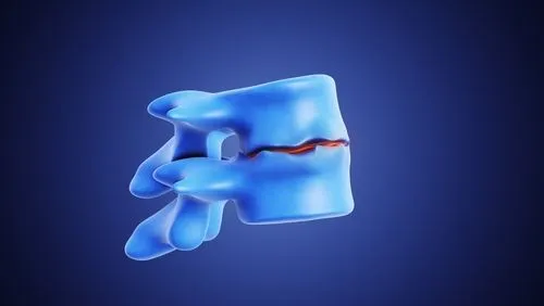3D anatomical model of spine showing degenerative disc disease.