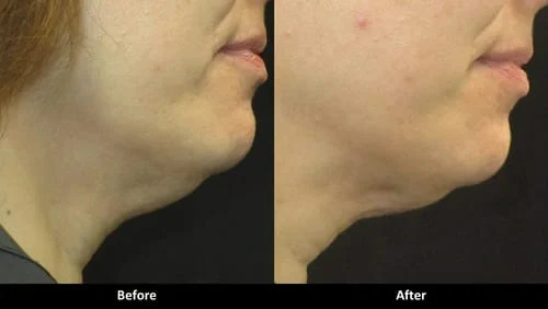 Kybella before and after