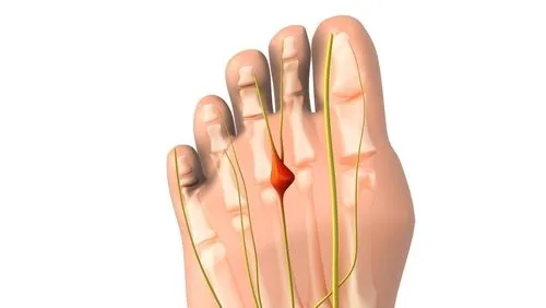 Medical illustration showing Morton's neuroma between the toes