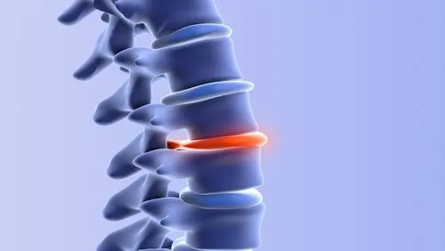 Illustration showing herniated disc