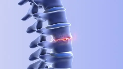 3D medical illustration showing spinal degeneration from degenerative disc disease