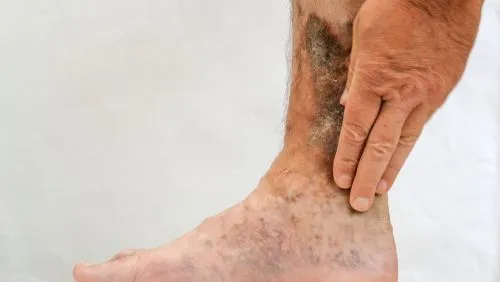 Illustration of Venous Ulcer on persons foot