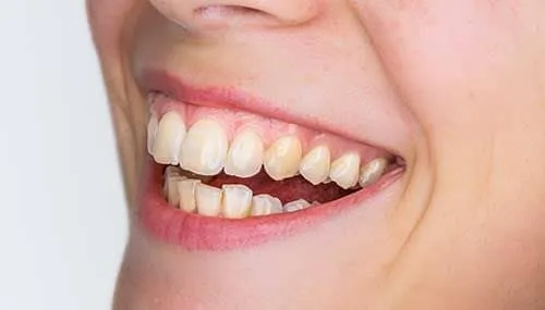 Before Cosmetic treatment - Dentist Brooksville FL