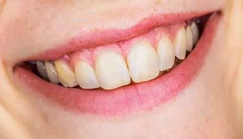 Before Teeth Whitening - Dentist Brooksville FL