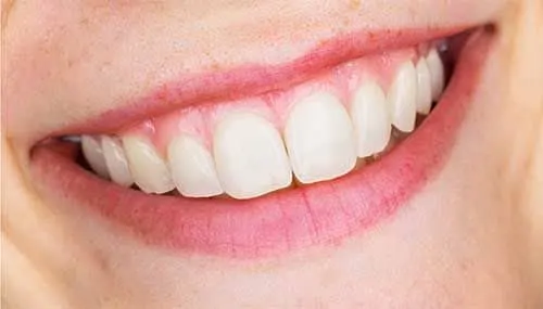 After Teeth Whitening - Dentist Brooksville FL