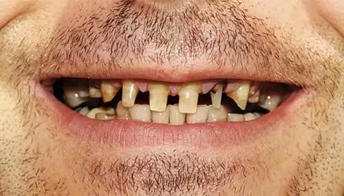 Before Dental Crowns - Dentist Brooksville FL