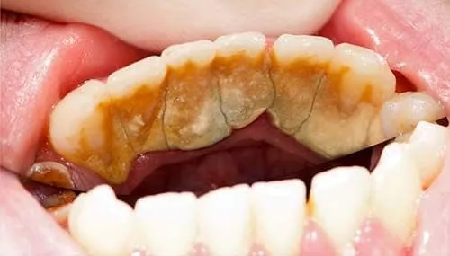 Before Restorative Dentistry- Dentist Brooksville FL