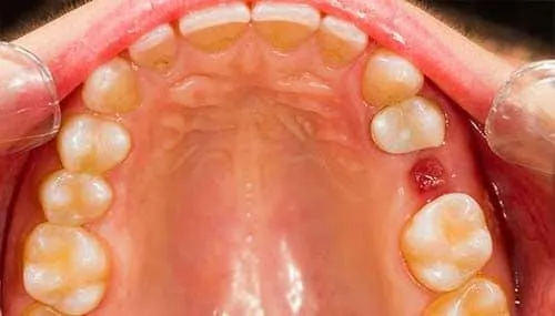 After Dental Reatment - Dentist Brooksville FL