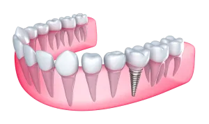 Dental Implants