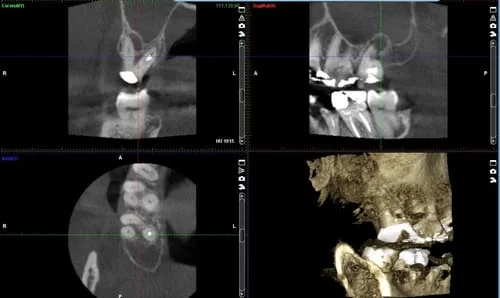 photo of a CBCT screenshot showing slices of a tooth in three different axis and a composite 3d model rendered by the computer software