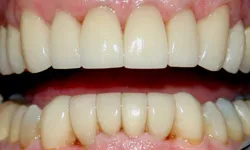 Restoration of front teeth using laminates - Dentistry by Dr.
Dean Sophocles