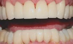 Restoration of front teeth using laminates - Dentistry by Dr. Dean
Sophocles