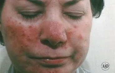 rosacea_landing.jpg