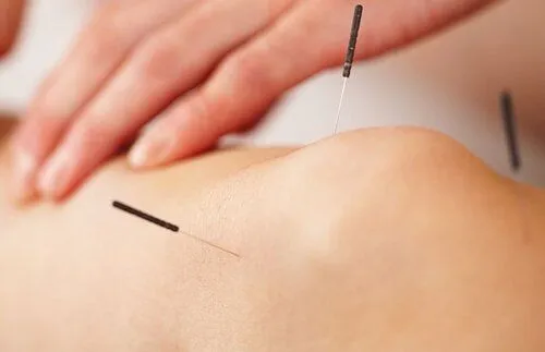 Dry Needling Falls Church VA 22046