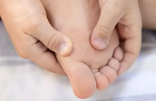 Illustration of Corn on foot of a person