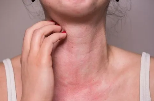 Itchy Rash on Neck
