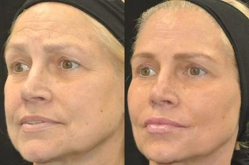 Liquid Facelift before and after