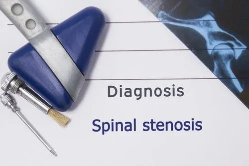 spinal stenosis