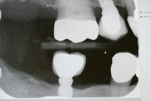  Implant restored 3 months later in 2015.