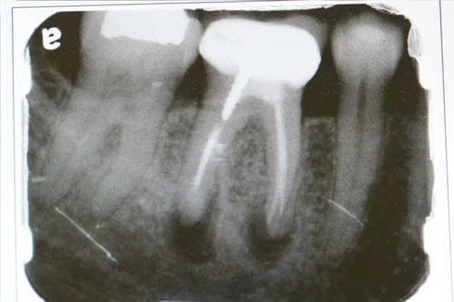 Yet another amazing extraction and immediate implant case of bone growth