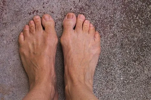 Top view of a foot showing a bunion deformity near the big toe