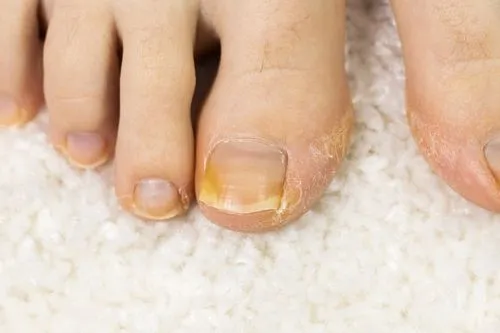 Toenail Fungus Treatment in Ridgefield, CT Serving Danbury & Redding, CT